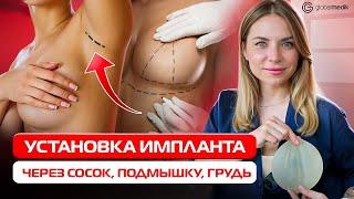 Лучшие способы установки имплантов для увеличения груди