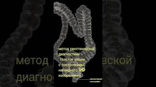 Кишечник на КТ-колоноскопии #доктор#shorts