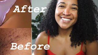 How To Lighten Dark Bikini Line For GOOD! No more dark spots.100% works!