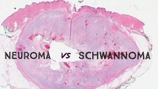 Neuroma vs Schwannoma? (palisaded encapsulated neuroma, nerve sheath tumor, dermpath, dermatology)