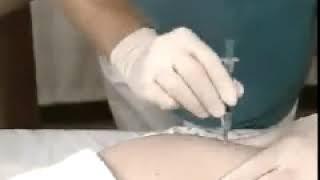 Medical Procedures: Z track method of Intramuscular Injection