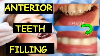Tooth Filling| Composite Dental Filling | Filling with composite | Front teeth filling
