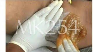 BRAZILIAN BIKINI LINE SUGARING SUGAR WAXING#brazilian #waxing #wax #sugaring #sugarwaxing