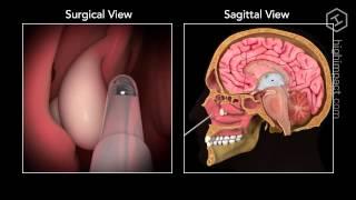 Nasal Polyp Removal