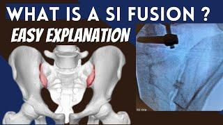 SI Joint Fusion  Explanation of how it can stop back pain permanently