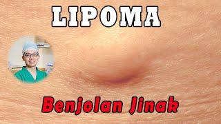 LIPOMA (Tumor Jinak) - Benjolan Lunak