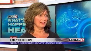 WKRC CBS Local 12 News Story about early detection of lymphedema