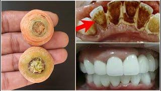 In 2 minutes, yellow will make dirty teeth white like pearl and shiny.Home remedy for teeth whitenin