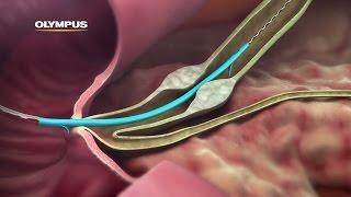 QuickPlaceV Biliary Stent