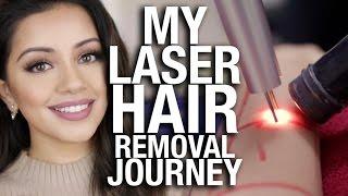 My Laser Hair Removal Journey