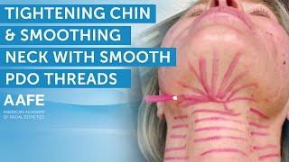 Tightening the Chin and Smoothing Neck with Smooth PDO Threads | AAFE