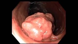 Gastric Endoscopic Submucosal Dissection (ESD)