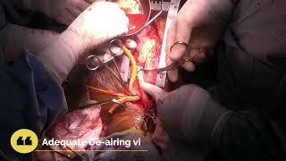 Aortic Arch Zone 0 debranching Surgery