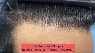 Hair Transplant Surgery | Dr.Alok Sahoo #hairtransformation #hairtransplantsuccesstories #hairstyle