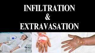 INFILTRATION VERSUS EXTRAVASATION (Cause, Management & Prevention) #nursing  #viral