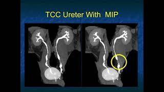 Transitional Cell Carcinoma of the Kidneys 2022: Pearls and Pitfalls - Part 1