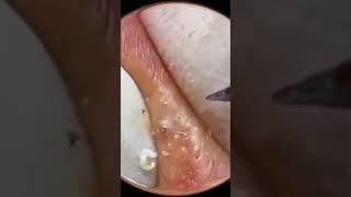 squeeze pimples satisfying Zoom / Pencet Jerawat #short #pimple #popping #satisfy