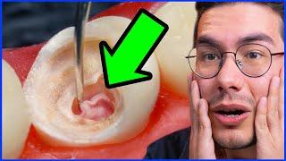 Removing a Tooth Nerve! | How is a Root Canal Done?