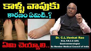 కాళ్ళ వాపులు ఎందుకు వస్తాయి .? | Dr CL Venkat Rao About  Leg Swelling |  Cl Venkat Rao Latest Video