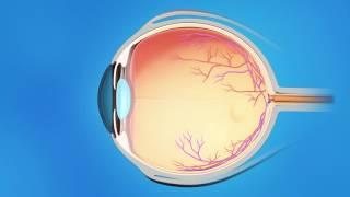 Trabecular Bypass Stent for Glaucoma