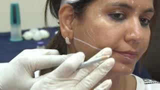 Complete video training on Botulinum Injections for face and Neck
