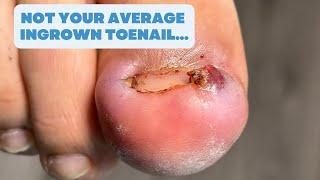 Not your average INGROWN TOENAIL...