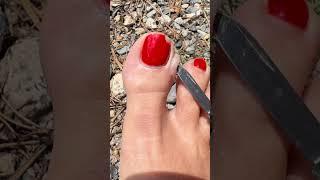 blister feet Pop #blister #feet #popping #viral