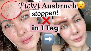 Meine -Methode: Pickel in 1 Tag loswerden