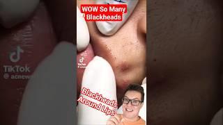 Beautiful BLACKHEAD REMOVAL From Lips - Blackheads Extraction #shorts