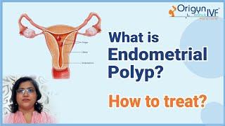 Polyp in uterus - Symptoms , tests and treatment