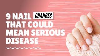 9 Nail Changes That Could  Mean Serious Disease️/  9 Nail Signs Of Health Problems 