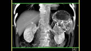 Abdomen: Pancreas: Pancreatic cystadenocarcinoma: Volume rendering of the tumor