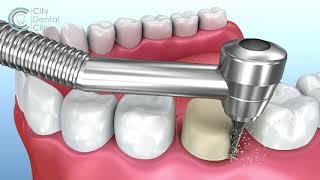 Dental crown treatment animation - English