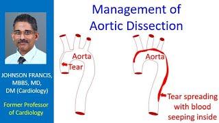 Management of Aortic Dissection