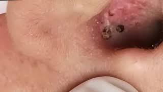 Compilation of Blackhead Removal from Ear