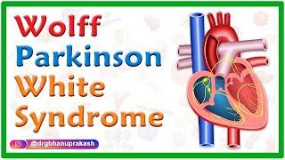 Wolff-Parkinson-White Syndrome (WPW) : Causes, Mechanism, ECG Findings and diagnosis, Treatment