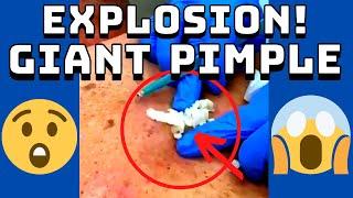 Giant Pimple Explosion Cyst Popping | Acne Pus Blackheads Bursting | ASMR Satisfying 36# 