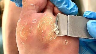 Foot callus removal & foot scraping dead skin 【DT Pedicure】#asmr