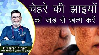 चेहरे की झाइयों को जड़ से ख़त्म करें || How to treat Melasma by homeopathy