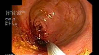 COLORECTAL STENT CHRISTOS KARALIS MD.mpg