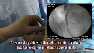 Cysto fluoroscopic technique for DJ stenting in Male