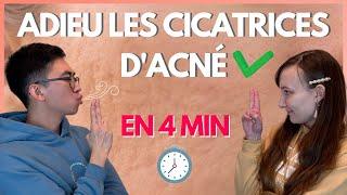 En finir avec les cicatrices d’acné (en 4 minutes) !