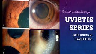 UVEITIS SERIES  Classification, Types and Pathology of Uveitis