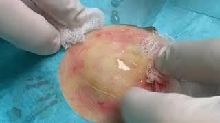 #Cyst drainage