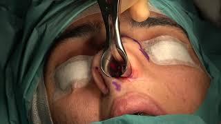 Septal Graft Obtaining-2: Bizrah Rhinoplasty