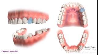 Upper 4 Lower 5 Extraction - Orthodontic Treatment