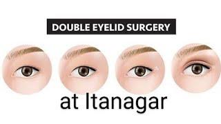 Asian Eye fold Surgery (#Asian Blepharoplasty, #doubleeyelidsurgery )