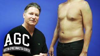 Abdominal Liposuction in Combination with Gynecomastia Treatment - Austin Gynecomastia Center