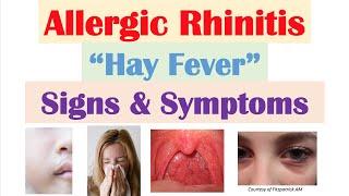 Allergic Rhinitis (Hay Fever & Seasonal Allergies) Signs & Symptoms (& Why They Occur)