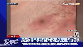 這波猴痘不典型 醫:局部皮疹.皮膚先現症狀｜TVBS新聞